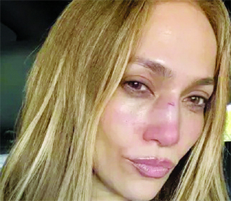 Jennifer Lopez suffers