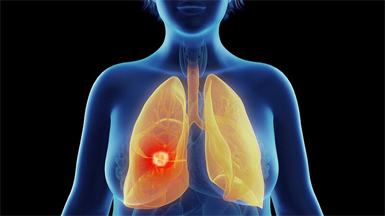 Women are at higher risk of lung disease
