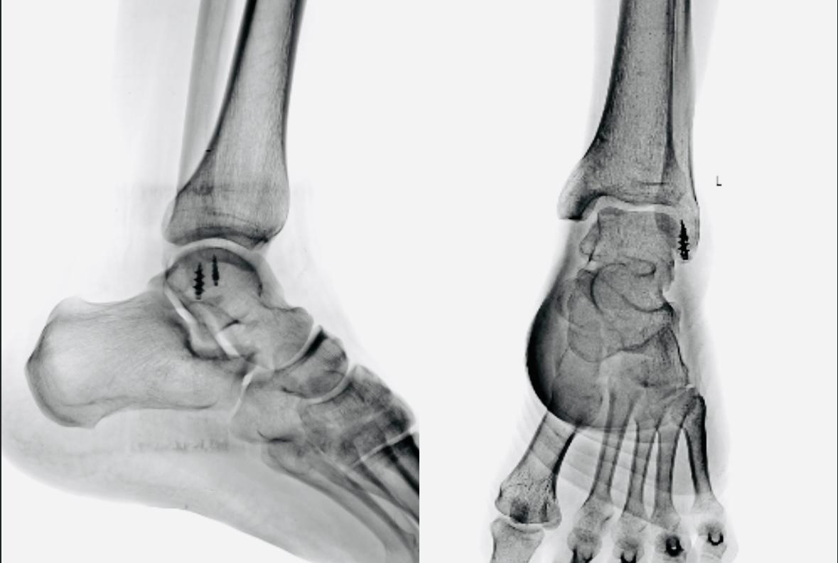 Rajasthan Surgeon Sets New Standard in Sports Surgery Excellence by fixing ligament reconstruction